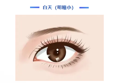 同样做近视手术，为啥有人会眩光？暗瞳是关键