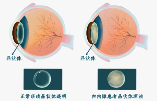 给眼睛“拨开迷雾”：一文读懂白内障的分类