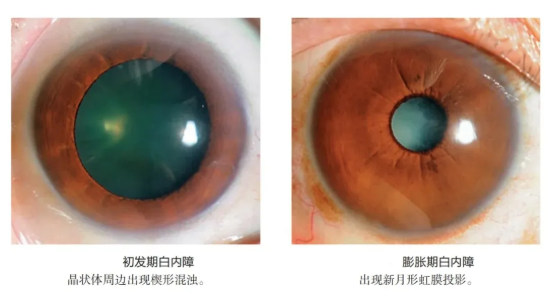 给眼睛“拨开迷雾”：一文读懂白内障的分类