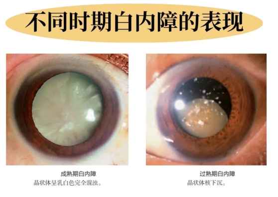 给眼睛“拨开迷雾”：一文读懂白内障的分类