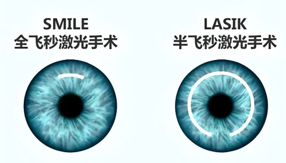 近视+散光双重困扰，现代科技：快速手术同步解决